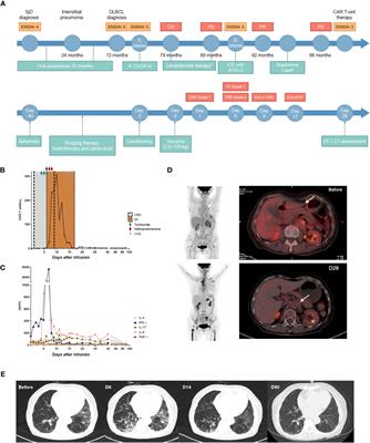 Concurrent remission of lymphoma and Sjögren’s disease following anti-CD19 chimeric antigen receptor-T cell therapy for diffuse large B-cell lymphoma: a case report